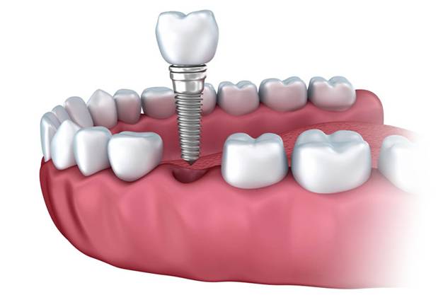 οδοντικά εμφυτεύματα